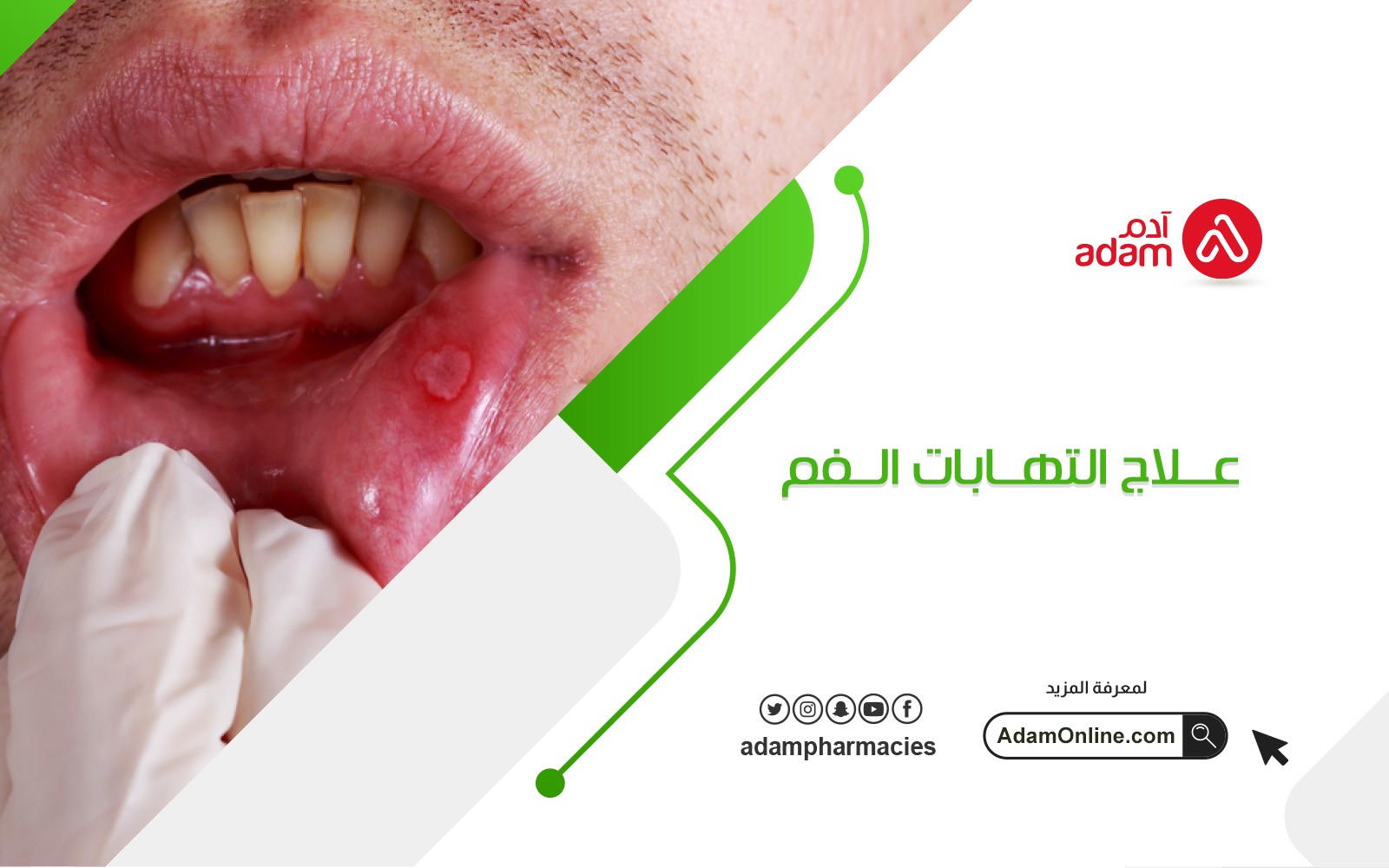 علاج التهابات الفم
